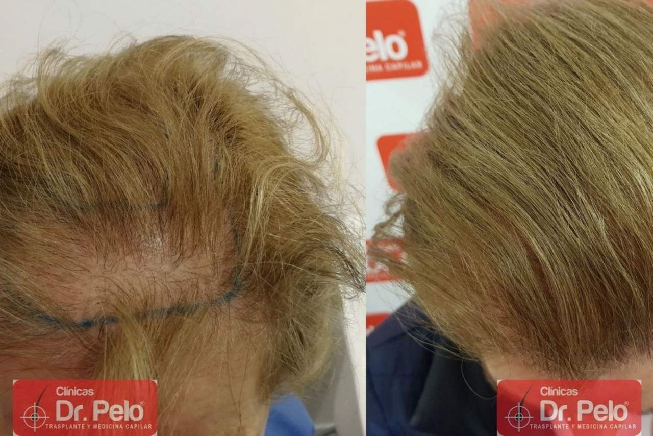 La Clínica Dr. Pelo y su injerto capilar en Sevilla