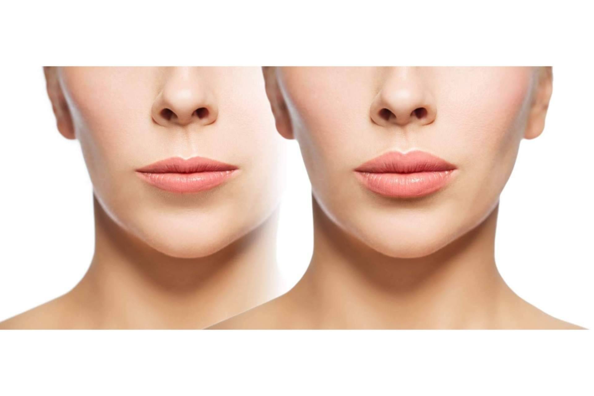 mesoINSTITUTE ofrece técnicas de bio-revitalización con mesoHYAC-16