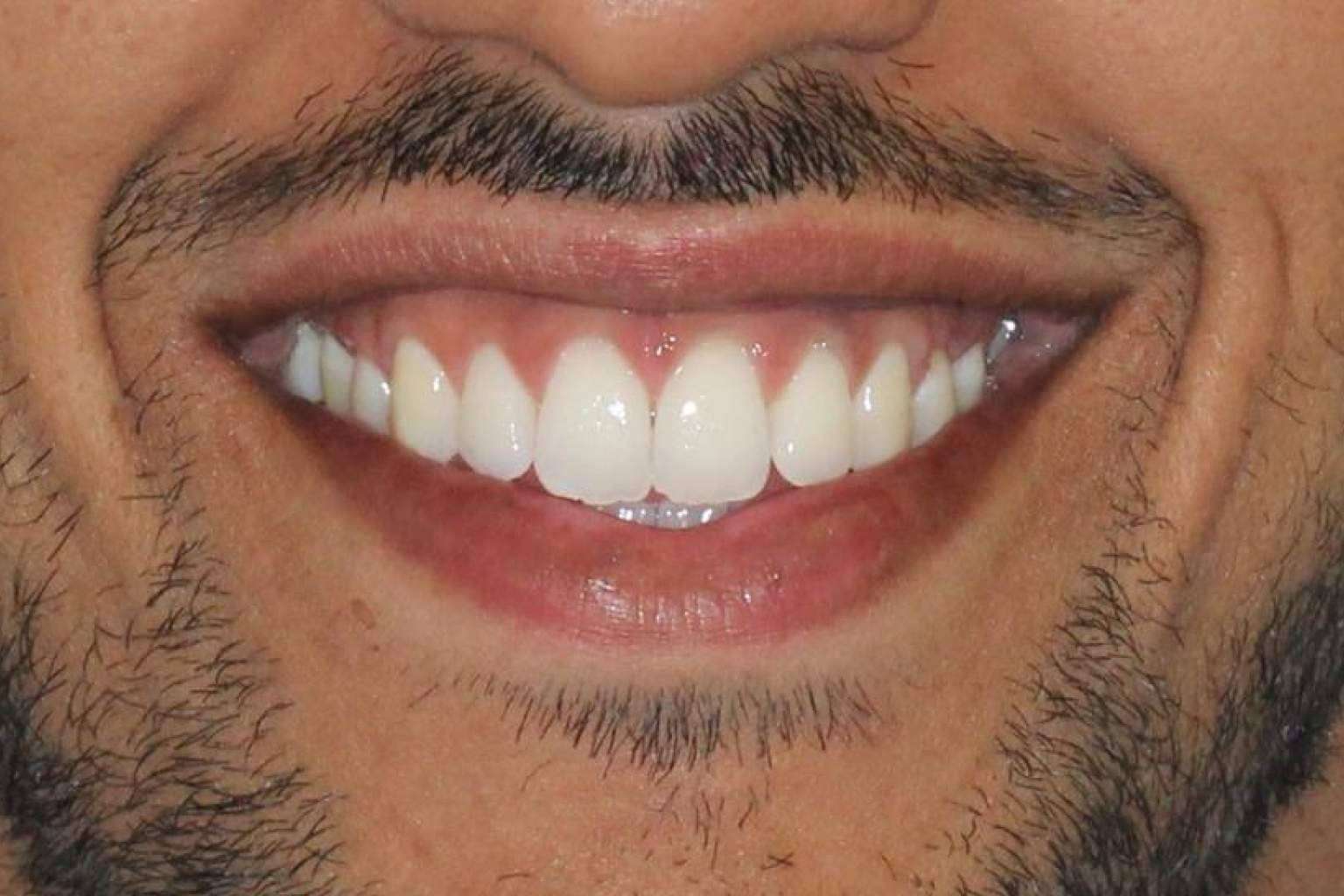 ¿Qué servicios de blanqueamientos dentales ofrece la Clínica Zahara?