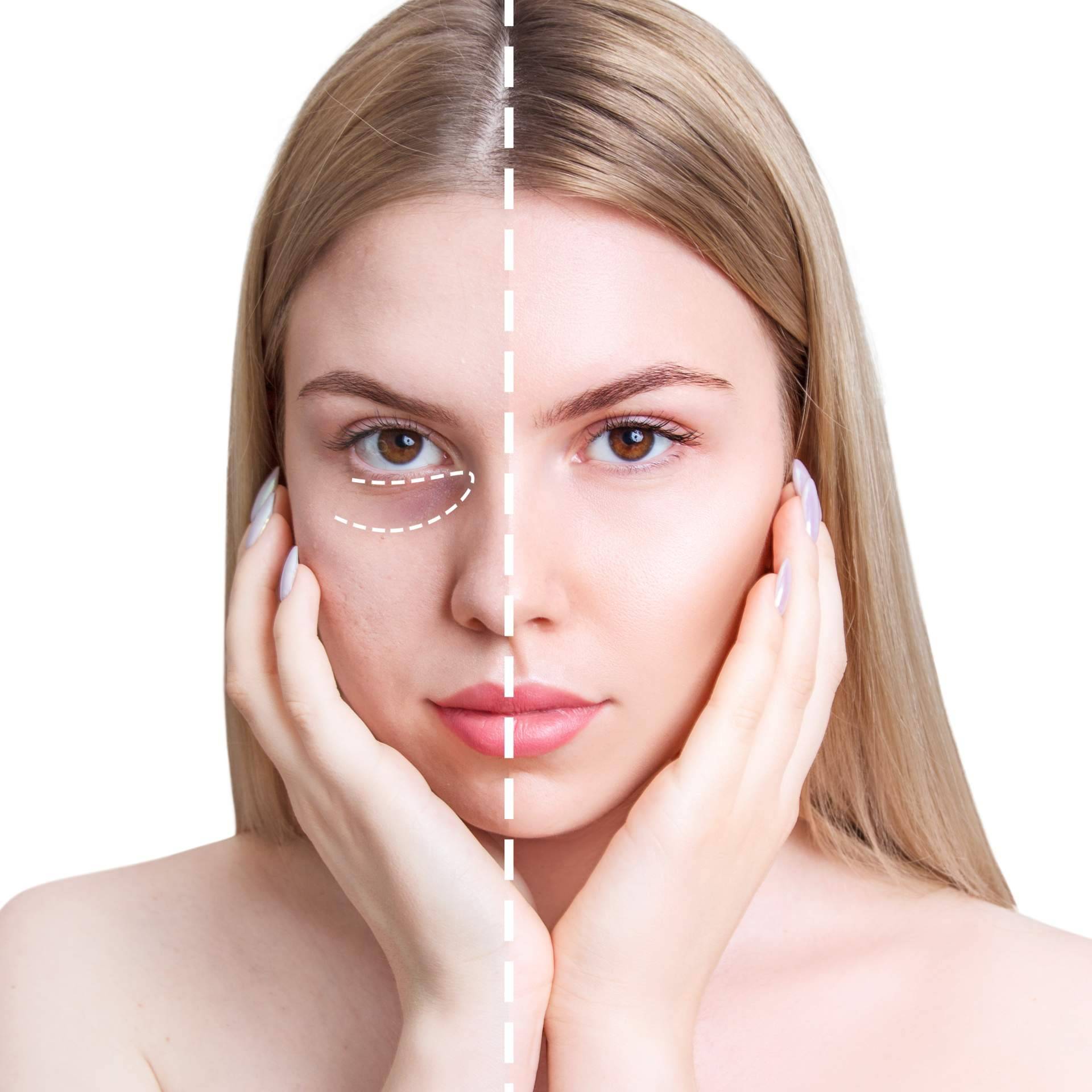 Eliminar las ojeras con ácido hialurónico, en Centro Estética El Pilar
